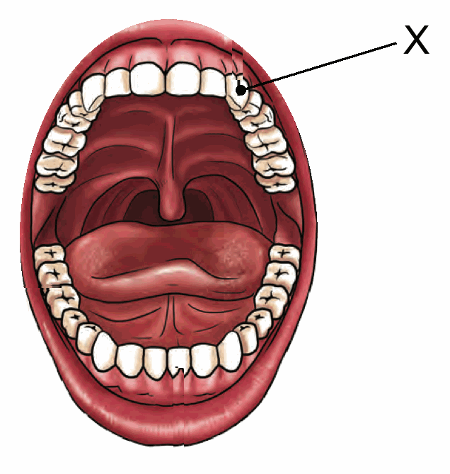 An open mouth with one pointed tooth beside the front teeth labelled X