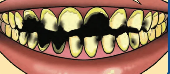 Teeth with black decay