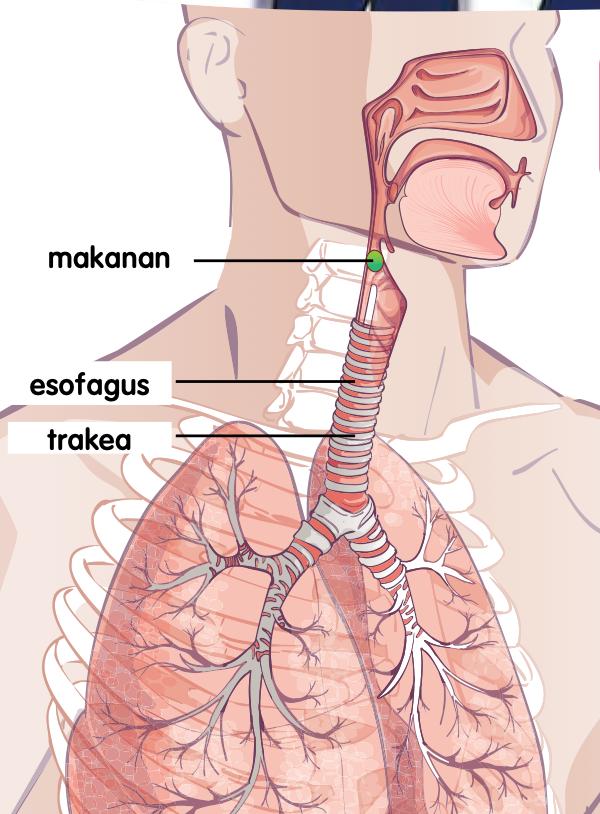 Makanan terperangkap di esofagus di sebelah trakea dan peparu