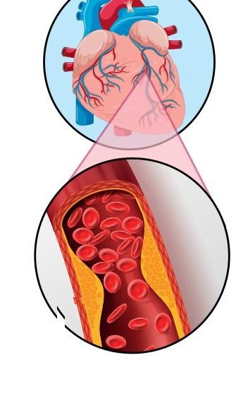 A heart and a blood vessel with a yellow layer building up inside it