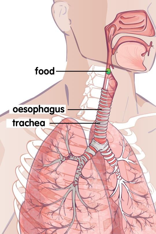 Food stuck in the oesophagus next to the trachea and lungs