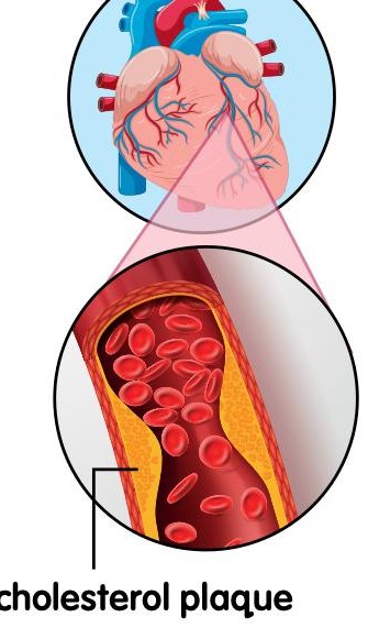 The heart and a blood vessel narrowed by cholesterol plaque