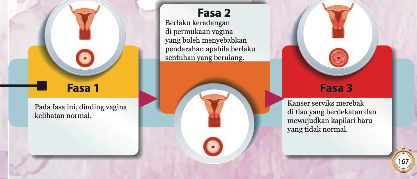 Tiga fasa kanser serviks dengan lukisan