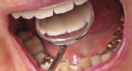A small dental mirror inside a patient's mouth
