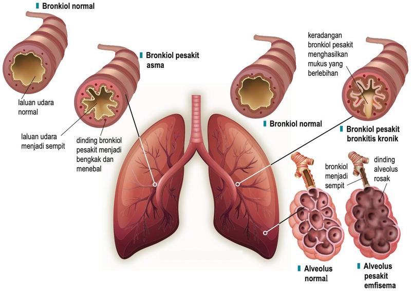 Bronkiol dan alveolus normal serta pesakit COPD