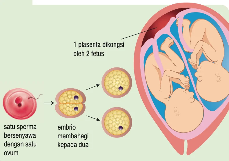 Satu sperma bersenyawa dengan satu ovum, embrio membahagi kepada dua; dua fetus berkongsi satu plasenta