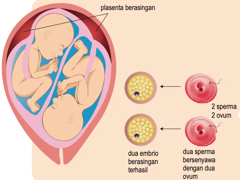 Dua sperma bersenyawa dengan dua ovum membentuk dua embrio berasingan; setiap fetus mempunyai plasenta sendiri