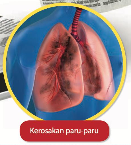 Ilustrasi paru-paru yang rosak dengan tompok gelap